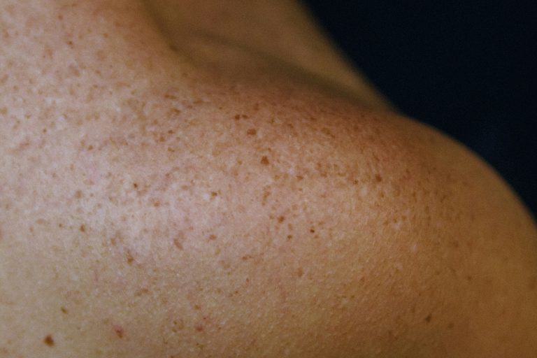 PIGMENTINĖS DĖMĖS: kodėl jos atsiranda ir kaip atgauti tolygią odos spalvą